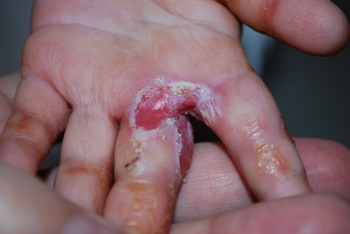 Bildresultat för infektion i sår